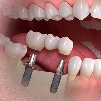 implantaciya.jpg
